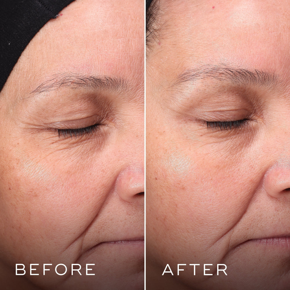 The Press & Glow Refill™ by Medik8 shows side-by-side results of reduced redness and smoother texture when using exfoliating poly hydroxy acids, making it ideal for those with sensitive skin.