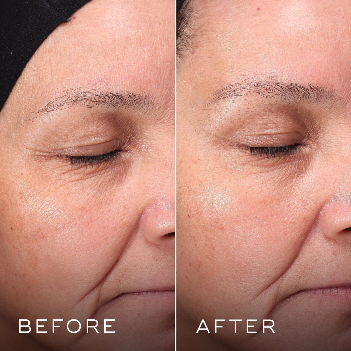 The Press & Glow Refill™ by Medik8 shows side-by-side results of reduced redness and smoother texture when using exfoliating poly hydroxy acids, making it ideal for those with sensitive skin.