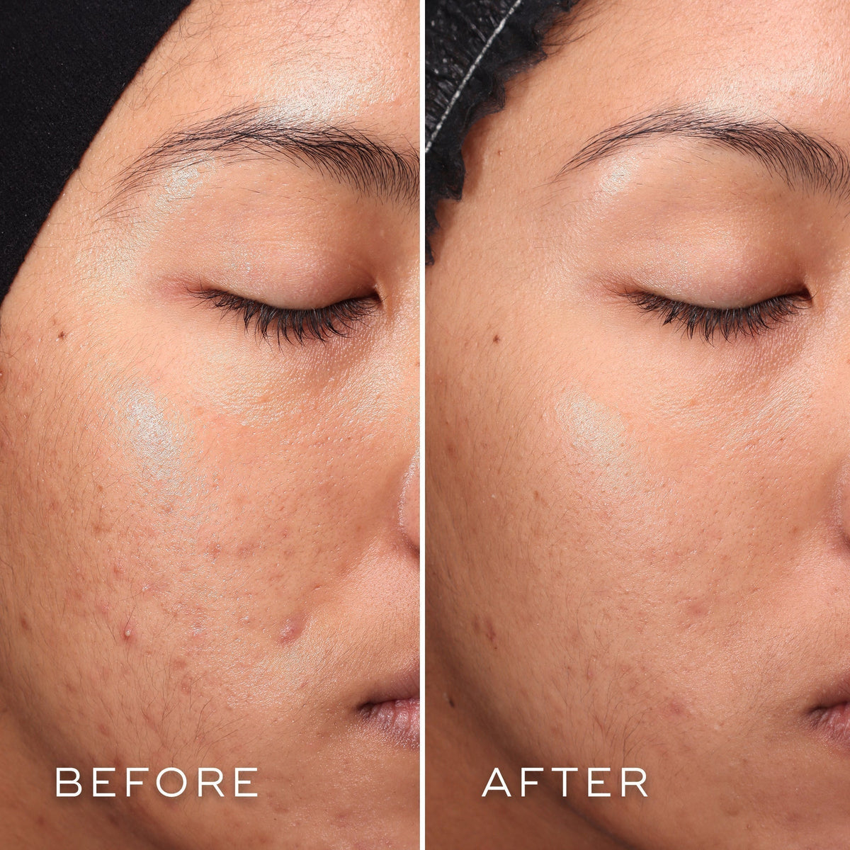 Comparison of a person's cheek showing improved skin texture and reduced acne from "before" to "after," thanks to the power of Salicylic Acid in Medik8's Press & Clear Refill™.