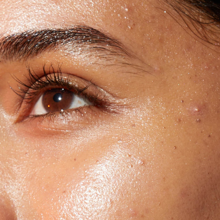 Women eye with blemish skin