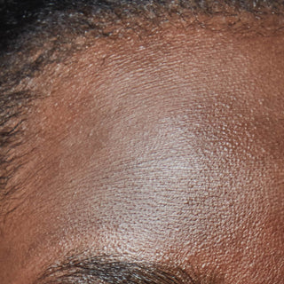 Dry and Dehydrated Skin
