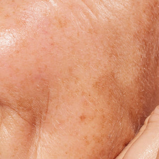 Hyperpigmented skin