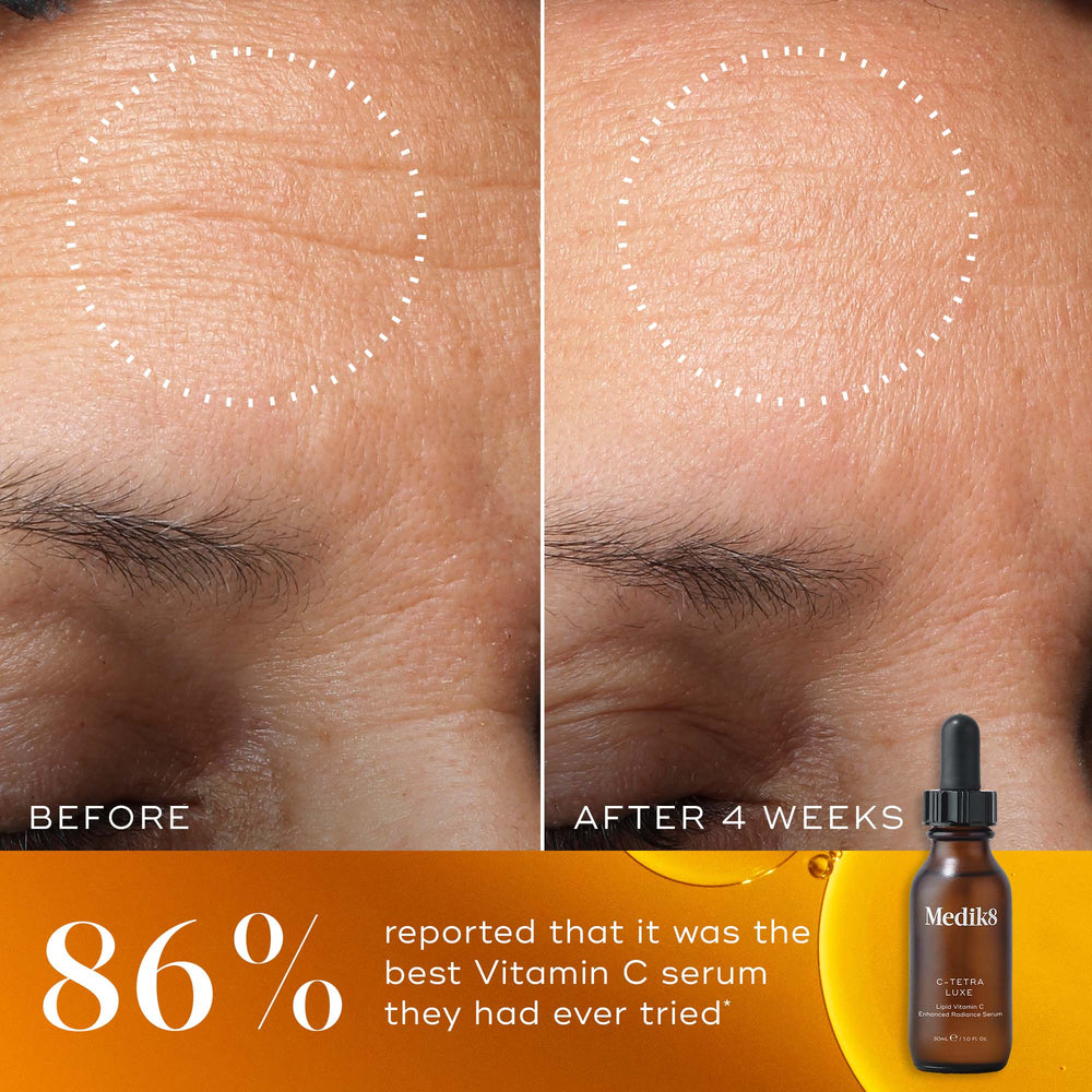 Side-by-side comparison of a forehead before and after using Medik8 C-Tetra® Luxe for 4 weeks, highlighting reduced wrinkles and diminished hyperpigmentation. Text notes that 86% rate it as the best Vitamin C serum they’ve tried.