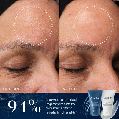 A "Before" and "After" comparison of a forehead shows visible lines smoothing with 94% improved moisturization after using Medik8's H.E.O.® Mask, highlighting its effectiveness in enhancing skin hydration overnight.