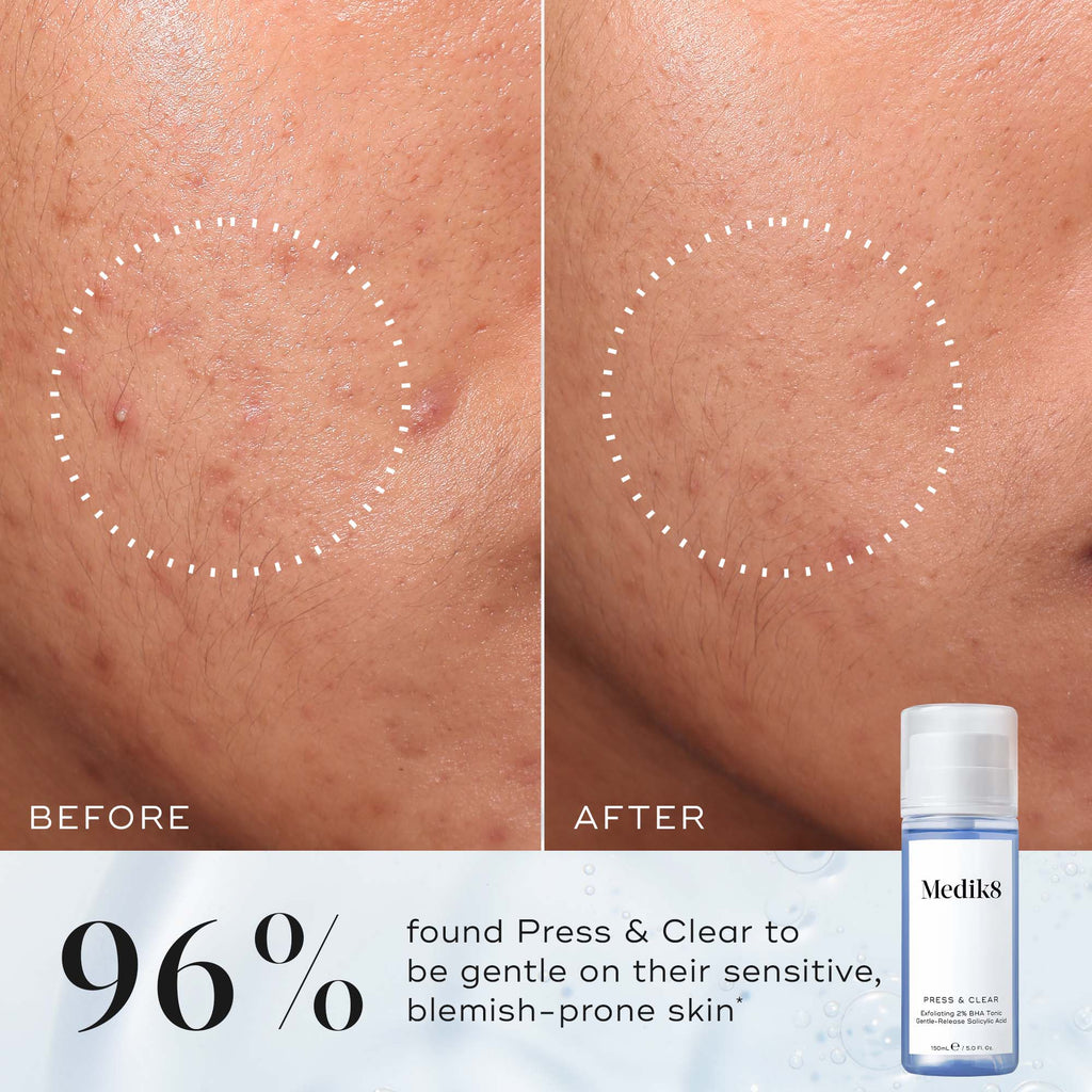 Close-up of blemish-prone skin labeled "Before" and clearer skin labeled "After." Text states 96% found Press & Clear™ gentle for sensitive skin. Medik8 product shown.
