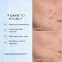 Before-and-after close-ups show visibly reduced blemishes and redness in 7 days, with noticeable results after 4 weeks using Medik8 Cyprus Niacinamide Peptides, a non-comedogenic, pore-refining 10% niacinamide serum.