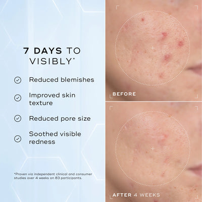 Before-and-after close-ups show visibly reduced blemishes and redness in 7 days, with noticeable results after 4 weeks using Medik8 Cyprus Niacinamide Peptides, a non-comedogenic, pore-refining 10% niacinamide serum.