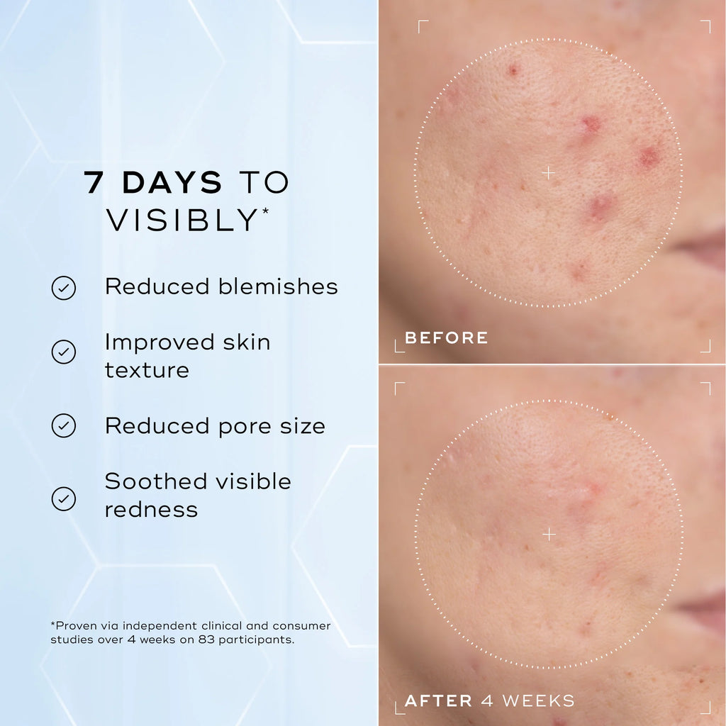 Before-and-after close-ups show visibly reduced blemishes and redness in 7 days, with noticeable results after 4 weeks using Medik8 Cyprus Niacinamide Peptides, a non-comedogenic, pore-refining 10% niacinamide serum.