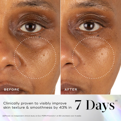 Close-up of a person's cheek and under-eye area before and after 7 days using Medik8 Cyprus Exo-PDRN Prismatic+, highlighting visibly smoother skin texture and reduced roughness.