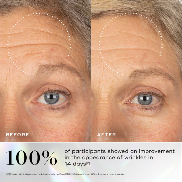 Close-up comparison of a woman's forehead and eye area before and after 14 days using Exo-PDRN Prismatic+ by Medik8 Cyprus, showing reduced wrinkles. Text states 100% of participants saw improvement in wrinkle appearance.-hover-